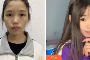 池州佳美皮膚美容醫(yī)院李光農(nóng)整形價(jià)格表附激光美膚祛斑案例展示