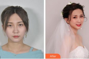 池州愛爾眼科醫(yī)院黃志強(qiáng)整形價(jià)格表附眼部綜合案例展示