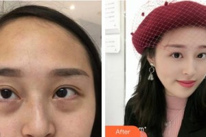 池州愛爾眼科醫(yī)院陳祥雷整形價(jià)格表附內(nèi)切祛眼袋案例展示