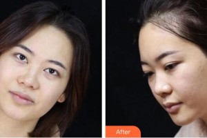 池州市人民醫(yī)院眼科姚有根整形價(jià)格表附眼鼻部手術(shù)案例展示