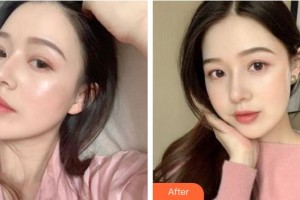 池州市人民醫(yī)院眼科汪鴻整形價(jià)格表附眼部綜合案例展示