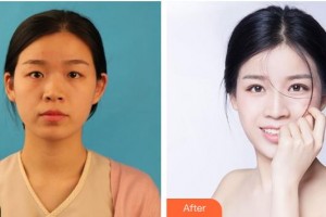 池州市人民醫(yī)院眼科楊健整形價(jià)格表附眼部綜合案例展示