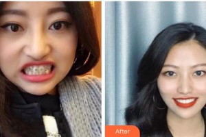 宣城為民口腔門診部王娟娟整形價(jià)格表附牙齒陶瓷矯正案例展示