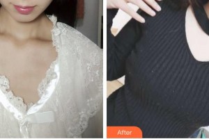 浙江綠城醫(yī)院整形美容中心丁路整形價(jià)格表附假體隆胸案例展示