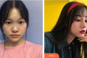 浙江省人民醫(yī)院整形外科石杭燕整形價(jià)格表附肋軟骨隆鼻案例展示