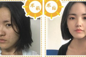 浙江省人民醫(yī)院整形外科張志民整形價(jià)格表附埋線提升案例展示