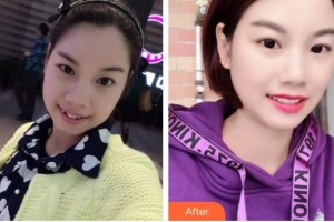 浙江大學(xué)醫(yī)學(xué)院附屬口腔醫(yī)院傅柏平整形價(jià)格表附金屬托槽矯正案例展示