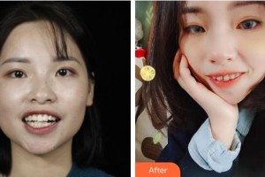 浙江大學(xué)醫(yī)學(xué)院附屬口腔醫(yī)院謝志堅(jiān)整形價(jià)格表附金屬托槽矯正案例展示