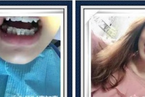 浙江大學(xué)醫(yī)學(xué)院附屬口腔醫(yī)院鄧淑麗整形價(jià)格表附牙齒隱形矯正案例展示