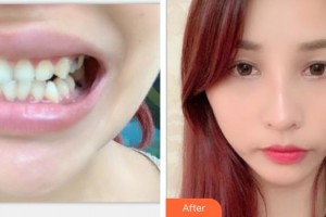 浙江大學(xué)醫(yī)學(xué)院附屬口腔醫(yī)院樊立潔整形價(jià)格表附牙齒隱形矯正案例展示