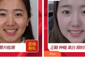 浙江大學(xué)醫(yī)學(xué)院附屬口腔醫(yī)院朱赴東整形價(jià)格表附冷光美白案例展示