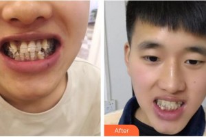 浙江大學(xué)醫(yī)學(xué)院附屬口腔醫(yī)院楊國(guó)利整形價(jià)格表附隱形托槽矯正案例展示