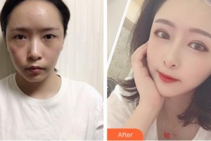 浙江省眼科醫(yī)院潘偉華整形價(jià)格表附眼部綜合案例展示