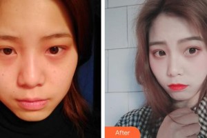 浙江大學(xué)醫(yī)學(xué)院附屬第四醫(yī)院整形美容科王守界整形價(jià)格表附眼部整形案例展示