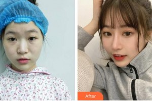 杭州整形醫(yī)院譚曉燕整形價(jià)格表附膨體隆鼻案例展示