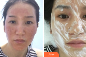 廣州海峽醫(yī)學(xué)整形美容醫(yī)院周紅英整形價格表附點(diǎn)陣激光祛痘印案例展示