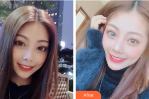 廣州雅度口腔門診部伍崇文整形價格表附牙齒美白案例展示