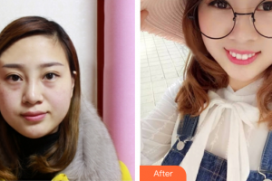 廣州拜博醫(yī)療美容門診部麥凱欣整形價格表附激光祛斑案例展示