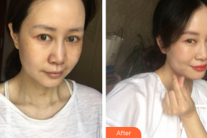 廣州美侖醫(yī)療美容門診部楊曉英整形價格表附超激光美膚祛斑案例展示