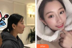 廣州凱美達(dá)整形美容醫(yī)院陽海斌整形價格表附耳軟骨鼻部手術(shù)案例展示