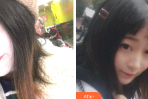 廣州圣貝口腔門診部詹春華整形價格表附金屬托槽矯正案例展示