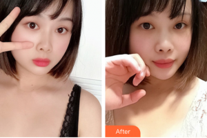 民航廣州醫(yī)院整形美容科陳新光整形價格表附自體脂肪隆胸案例展示