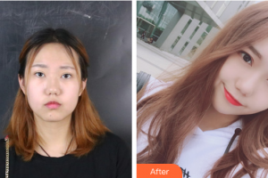 廣州醫(yī)科大學(xué)附屬第一醫(yī)院整形外科王肅生整形價格表附創(chuàng)可貼面部吸脂案例展示