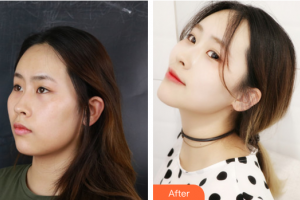 廣州博仕整形美容醫(yī)院李帥敏整形價格表附創(chuàng)可貼面部吸脂瘦臉術(shù)案例展示