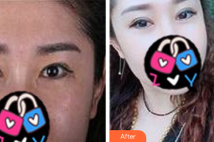 廣州圣諾達(dá)醫(yī)療美容門診部周豐整形價格表附重臉術(shù)修復(fù)案例展示