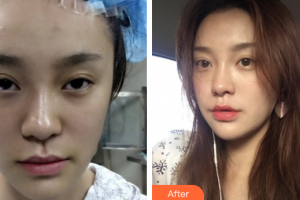 廣州圣諾達(dá)醫(yī)療美容門診部吳偉航整形價格表附埋線提升案例展示