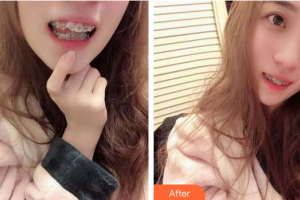 廣州穗華口腔醫(yī)院賀文鵬整形價格表附美牙案例展示