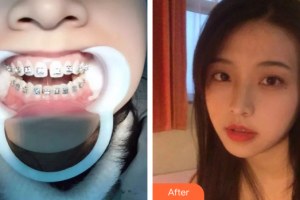廣州穗華口腔醫(yī)院張錫金整形價格表附隱形托槽矯正案例展示