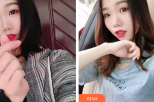 廣州穗華口腔醫(yī)院張昆茂整形價格表附超聲波潔牙案例展示