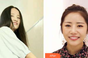 廣州穗華口腔醫(yī)院張濤整形價格表附隱形牙套矯正案例展示