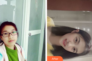 廣州穗華口腔醫(yī)院陳凌鋒整形價格表附牙齒矯正案例展示