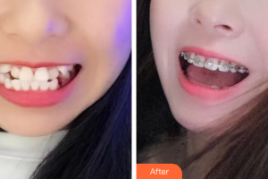 廣州穗華口腔醫(yī)院劉勝文整形價格表附金屬托槽矯正案例展示