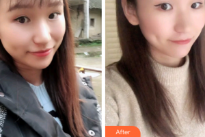 廣州穗華口腔醫(yī)院陳旭峰整形價(jià)格表附牙齒瓷貼面案例展示