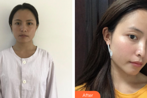 廣州深美醫(yī)療美容門診部鄧海清整形價(jià)格表附面部吸脂案例展示