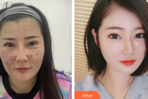 廣州深美醫(yī)療美容門診部曾立整形價(jià)格表附熱瑪吉案例展示