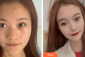 廣州姬妍醫(yī)療美容門診部龔湛整形價(jià)格表附鼻部手術(shù)案例展示