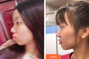 廣州愛(ài)康健口腔門診部周小明整形價(jià)格表附金屬托槽矯正案例展示