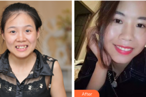 廣州愛(ài)康健口腔門診部楊巍華整形價(jià)格表附金屬托槽矯正案例展示