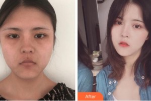 杭州整形醫(yī)院何葆華整形價(jià)格表附埋線(xiàn)提升案例展示