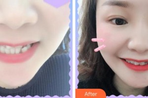 杭州時(shí)光醫(yī)療美容醫(yī)院黃錦英整形價(jià)格表附口腔矯正案例展示