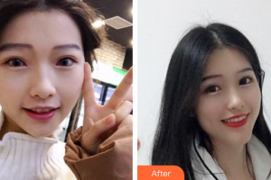 廣州愛康健口腔門診部盧勇輝整形價格表附隱形矯正案例展示