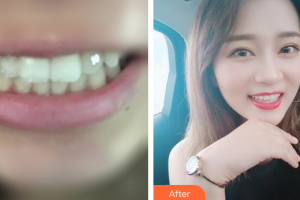 廣州愛康健口腔門診部林露露整形價格表附金屬托槽矯正案例展示