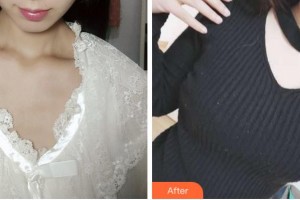 杭州華山連天美醫(yī)療美容整形醫(yī)院馮國(guó)松整形價(jià)格表附隆胸案例展示