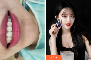 廣州市荔灣區(qū)口腔醫(yī)院趙月萍整形價格表附隱適美全隱形矯正案例展示