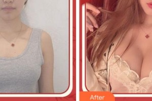 杭州華山連天美醫(yī)療美容整形醫(yī)院李超整形價(jià)格表附自體脂肪隆胸案例展示