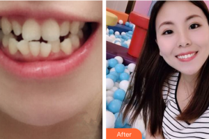 廣州健業(yè)口腔醫(yī)院安斯耀整形價(jià)格表附金屬托槽矯正案例展示